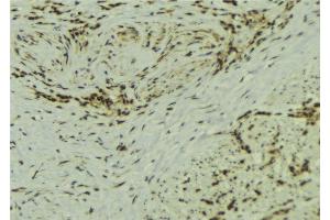 ABIN6273106 at 1/100 staining Human breast cancer tissue by IHC-P. (SS18L1 anticorps)