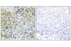Immunohistochemistry analysis of paraffin-embedded human liver carcinoma tissue using CARKL antibody.