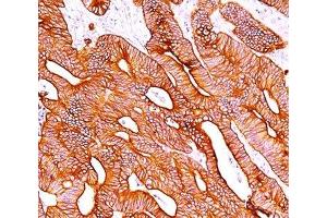 IHC staining of colon carcinoma with pan Cytokeratin antibody cocktail AE1 + AE3. (pan Keratin anticorps)