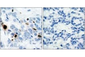 Immunohistochemistry analysis of paraffin-embedded human breast carcinoma, using Histone H3. (Histone H3.1 anticorps  (pSer10))
