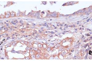 Immunohistochemistry of paraffin-embedded Human lung cancer using RPL32 Polyclonal Antibody at dilution of 1:100 (40x lens).