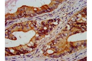 IHC image of ABIN7167616 diluted at 1:300 and staining in paraffin-embedded human colon cancer performed on a Leica BondTM system.