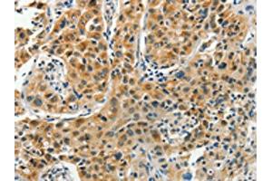 The image on the left is immunohistochemistry of paraffin-embedded Human lung cancer tissue using ABIN7191847(PFDN6 Antibody) at dilution 1/35, on the right is treated with synthetic peptide. (PFDN6 anticorps)