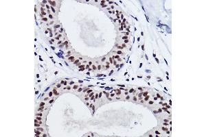 Immunohistochemistry of paraffin-embedded human breast cancer using SNRP Rabbit mAb (ABIN7270365) at dilution of 1:100 (40x lens). (SNRPA1 anticorps)