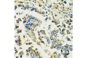 Immunohistochemistry of paraffin-embedded human colon carcinoma using SLC25 antibody (ABIN6132660, ABIN6147903, ABIN6147904 and ABIN6224187) at dilution of 1:100 (40x lens). (SLC25A11 anticorps  (AA 1-314))
