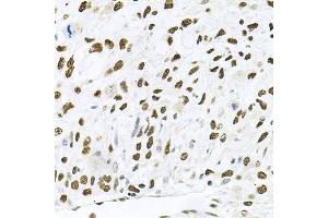 Immunohistochemistry of paraffin-embedded human lung cancer using MAPK8 antibody.