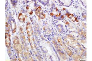 Formalin-fixed and paraffin embedded human gastric carcinoma labeled with Rabbit Anti-EDA2R Polyclonal Antibody, Unconjugated  at 1:200 followed by conjugation to the secondary antibody and DAB staining (Ectodysplasin A2 Receptor anticorps  (AA 51-150))