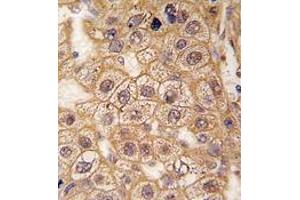 Formalin-fixed and paraffin-embedded human hepatocarcinoma tissue reacted with BAR2 Antibody , which was peroxidase-conjugated to the secondary antibody, followed by DAB staining. (beta 2 Adrenergic Receptor anticorps  (Ser261))