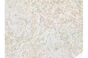 ABIN6255118 and ABIN6267547 at 1/100 staining human tongue carcinoma by IHC-P. (VASP anticorps  (pSer239))