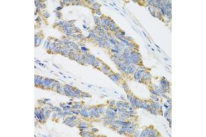 Immunohistochemistry of paraffin-embedded human colon carcinoma using CYP1A1 antibody (ABIN5971186) at dilution of 1/100 (40x lens). (CYP1A1 anticorps)