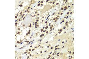 Immunohistochemistry of paraffin-embedded human kidney cancer using PRKDC antibody at dilution of 1:100 (x400 lens).