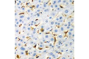 Immunohistochemistry of paraffin-embedded human liver injury using CD68 antibody (ABIN5975414) at dilution of 1/100 (40x lens). (CD68 anticorps)