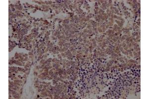 IHC image of ABIN7127369 diluted at 1:100 and staining in paraffin-embedded human lung cancer performed on a Leica BondTM system. (Recombinant BMI1 anticorps)