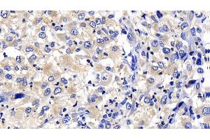 Detection of CASP8 in Human Liver cancer Tissue using Polyclonal Antibody to Caspase 8 (CASP8)