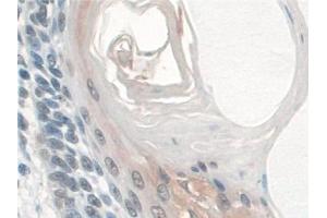 Detection of BANF1 in Human Skin cancer Tissue using Polyclonal Antibody to Barrier To Autointegration Factor 1 (BANF1)