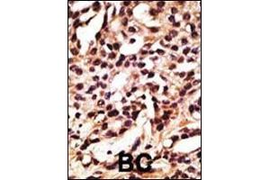 Formalin-fixed and paraffin-embedded human cancer tissue reacted with the primary antibody, which was peroxidase-conjugated to the secondary antibody, followed by DAB staining. (ATG12 anticorps  (N-Term))