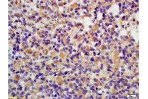 Formalin-fixed and paraffin embedded human brain glioblastoma labeled with Anti-Phospho-Lyn (Tyr397) Polyclonal Antibody, Unconjugated (ABIN743618) at 1:200 followed by conjugation to the secondary antibody and DAB staining