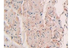Detection of Sp100 in Human Esophagus cancer Tissue using Polyclonal Antibody to Sp100 Nuclear Antigen (Sp100) (SP100 anticorps  (AA 610-802))