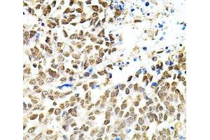 Immunohistochemistry of paraffin-embedded Human lung cancer using PNKP Polyclonal Antibody at dilution of 1:100 (40x lens). (PNKP anticorps)