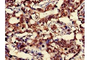 Immunohistochemistry of paraffin-embedded human gastric cancer using ABIN7149162 at dilution of 1:100