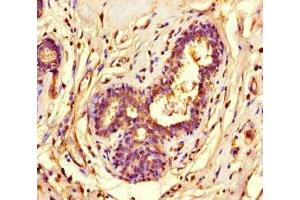 Immunohistochemistry of paraffin-embedded human breast cancer using ABIN7155525 at dilution of 1:100 (SUV39H1 anticorps  (AA 179-412))