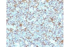 Formalin-fixed, paraffin-embedded human Ewing's sarcoma stained with CD99 antibody (MIC2/877). (CD99 anticorps)