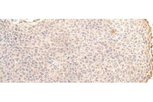 Immunohistochemistry of paraffin-embedded Human cervical cancer tissue using ZNF263 Polyclonal Antibody at dilution of 1:30(x200)