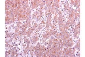 IHC-P Image PGD antibody detects PGD protein at cytoplasm on human breast carcinoma by immunohistochemical analysis. (PGD anticorps)