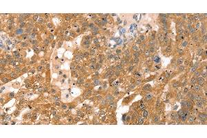 Immunohistochemistry of paraffin-embedded Human breast cancer using RPS6KA1 Polyclonal Antibody at dilution of 1:30 (RPS6KA1 anticorps)