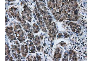 Immunohistochemical staining of paraffin-embedded Carcinoma of liver tissue using anti-HSPA1Amouse monoclonal antibody. (HSP70 1A anticorps)
