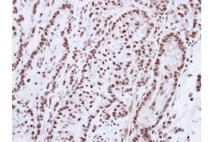 IHC-P Image Immunohistochemical analysis of paraffin-embedded A549 xenograft, using Progesterone receptor, antibody at 1:100 dilution.