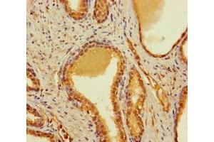 Immunohistochemistry of paraffin-embedded human prostate cancer using ABIN7148034 at dilution of 1:100 (CBWD2 anticorps  (AA 96-395))