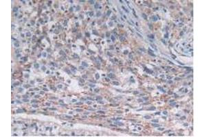 IHC-P analysis of Human Lung Cancer Tissue, with DAB staining. (SNX13 anticorps  (AA 97-284))
