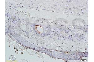 Formalin-fixed and paraffin embedded mouse cancer tissue labeled with Anti-AGPAT4 Polyclonal Antibody, Unconjugated (ABIN708671) at 1:200 followed by conjugation to the secondary antibody, (SP-0023), and DAB staining (AGPAT4 anticorps  (AA 231-330))