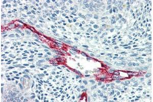 Human Uterus, Vessels (formalin-fixed, paraffin-embedded) stained with F8 antibody ABIN396921 at 10 ug/ml followed by biotinylated anti-mouse IgG secondary antibody ABIN481714, alkaline phosphatase-streptavidin and chromogen. (Factor VIII anticorps)