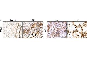 LOX/L expression in human IPF lungs.