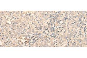 Immunohistochemistry of paraffin-embedded Human cervical cancer tissue using PNKD Polyclonal Antibody at dilution of 1:35(x200) (PNKD anticorps)