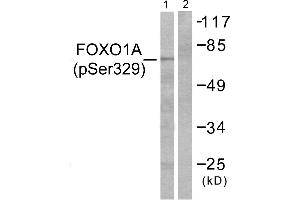 Immunohistochemistry analysis of paraffin-embedded human breast carcinoma tissue using FOXO1A (Phospho-Ser329) antibody. (FOXO1 anticorps  (pSer329))