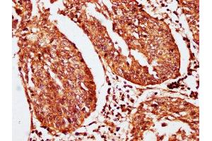 IHC image of ABIN7163536 diluted at 1:200 and staining in paraffin-embedded human cervical cancer performed on a Leica BondTM system.