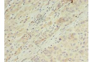 Immunohistochemistry of paraffin-embedded human liver cancer using ABIN7143481 at dilution of 1:100 (ARL14 anticorps  (AA 2-192))