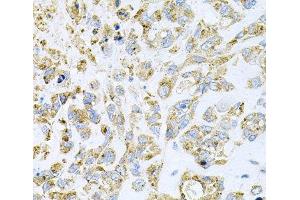 Immunohistochemistry of paraffin-embedded Human lung cancer using HDAC3 Polyclonal Antibody at dilution of 1:100 (40x lens). (HDAC3 anticorps)