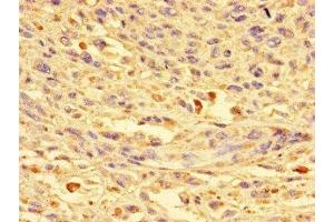 Immunohistochemistry of paraffin-embedded human melanoma using ABIN7149360 at dilution of 1:100 (CKAP2L anticorps  (AA 246-413))