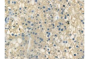 ABIN6266367 and ABIN6273361 at 1/100 staining human hepatocellular carcinoma by IHC-P. (LRRC42 anticorps  (N-Term))