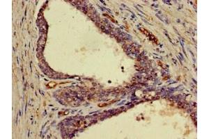 Immunohistochemistry of paraffin-embedded human prostate cancer using ABIN7152845 at dilution of 1:100 (FRS2 anticorps  (AA 116-387))