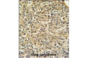 Merlin Antibody (N-term) (ABIN390756 and ABIN2841014) IHC analysis in formalin fixed and paraffin embedded human lung carcinoma followed by peroxidase conjugation of the secondary antibody and DAB staining. (Merlin anticorps  (N-Term))