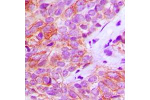 Immunohistochemical analysis of FGFR3 staining in human breast cancer formalin fixed paraffin embedded tissue section. (FGFR3 anticorps  (Center))