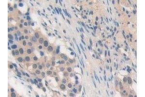 Detection of MMP19 in Human Lung cancer Tissue using Polyclonal Antibody to Matrix Metalloproteinase 19 (MMP19)