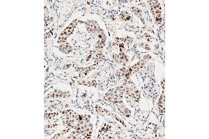 Immunohistochemical analysis of paraffin-embedded Human breast carcinoma tissue using A performed on the Leica® BOND RXm. (HIST1H3B3 (pSer10) anticorps)