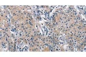 Immunohistochemistry of paraffin-embedded Human gastric cancer using TRIP4 Polyclonal Antibody at dilution of 1:50