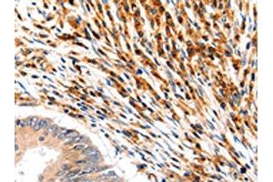 The image on the left is immunohistochemistry of paraffin-embedded Human colon cancer tissue using ABIN7192466(SLC2A5 Antibody) at dilution 1/12, on the right is treated with synthetic peptide. (SLC2A5 anticorps)